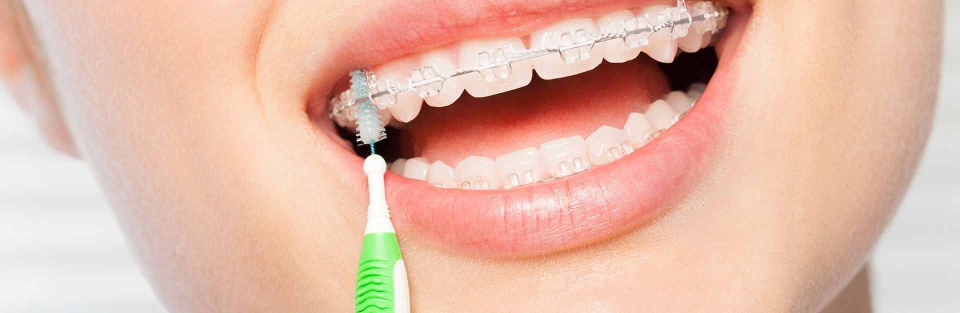 A woman is using clear braces