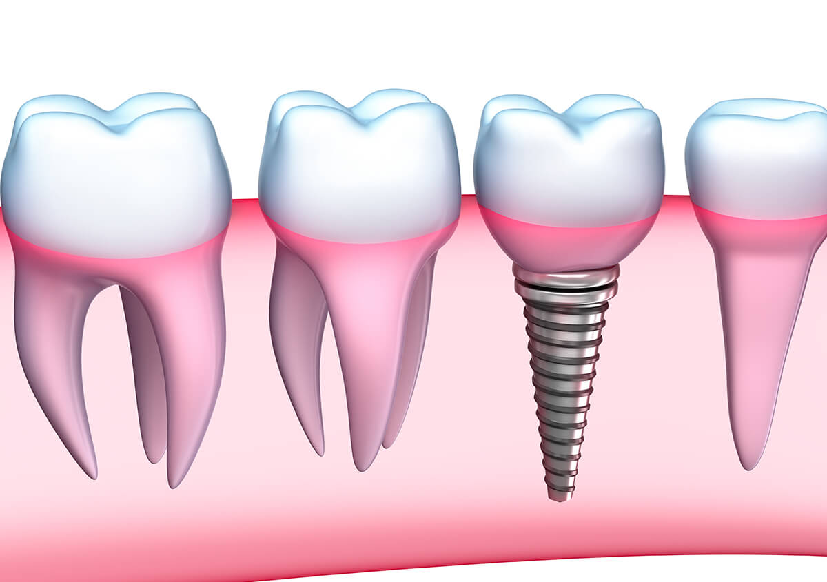 Dental Implants Services in Longmont CO Area
